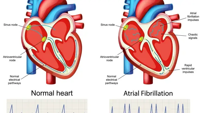 A graphic image of a heart in normal sinus rhythm and one in AFib