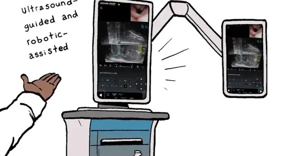 Virtual drawing showing a Procept Biorobotics Hydros system with text reading "ultrasound-guided and robotic-assisted"
